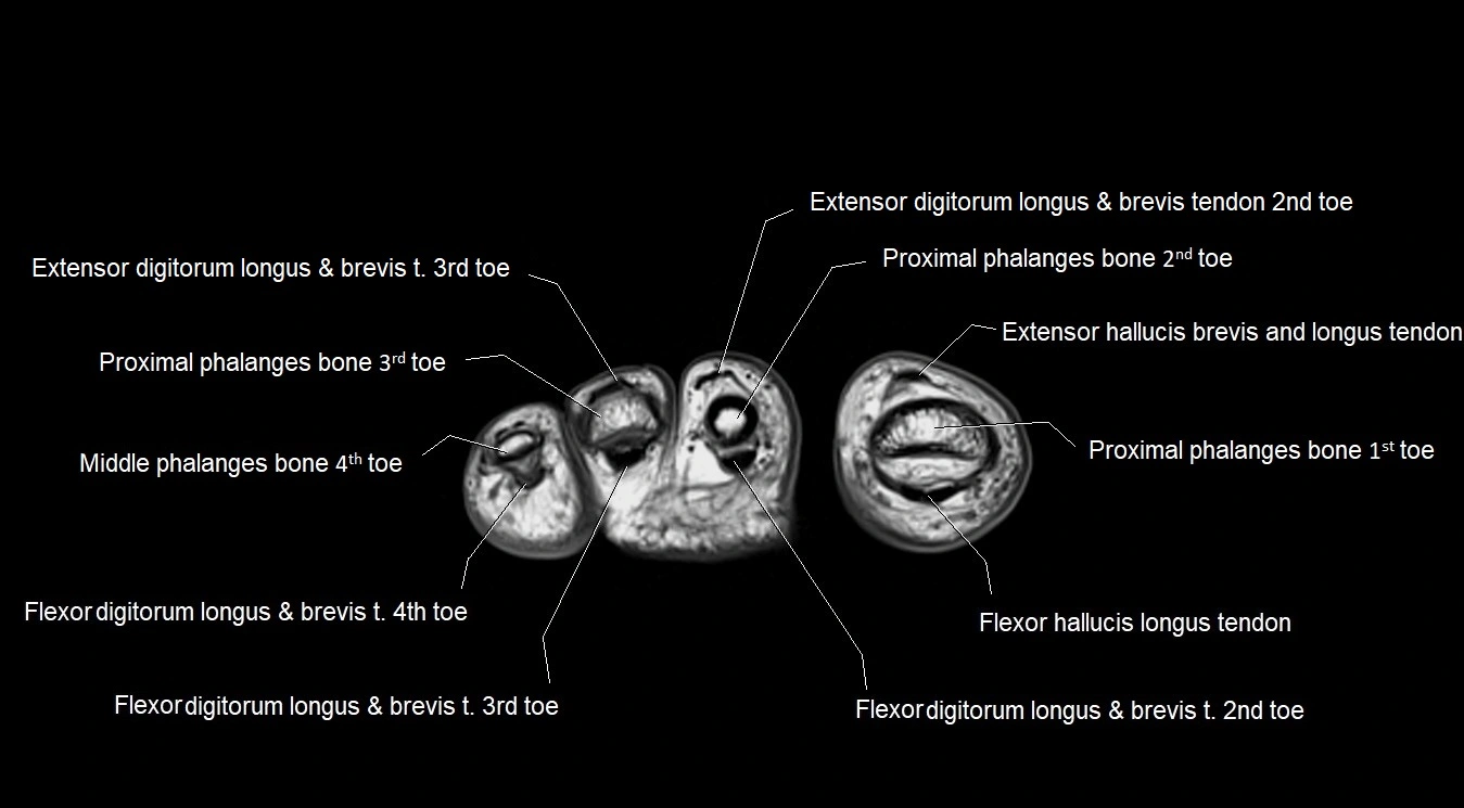 MRI 3T foot axial cross sectional anatomy image 35.webp